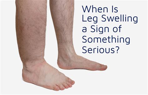 What Causes Leg Edema In The Elderly
